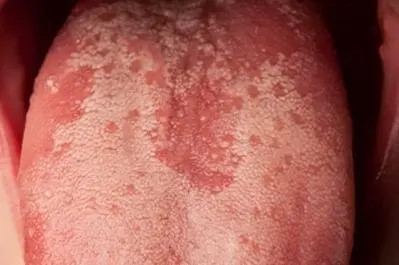 candida growth on tongue